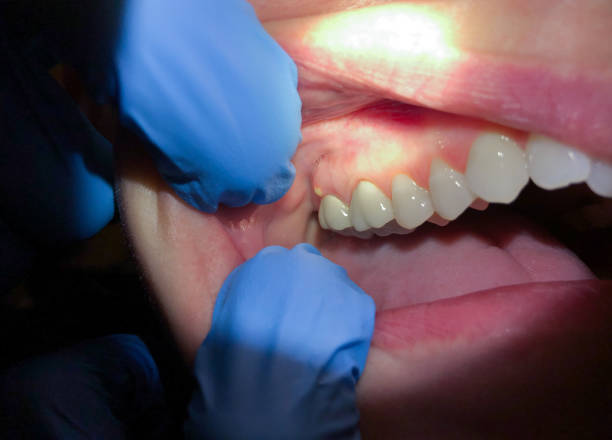 Best Emergency Dental Care for Broken or Chipped Teeth in Mountain View Acres, CA